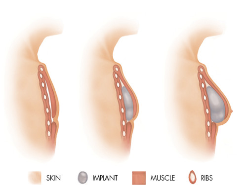 Types of breast reconstruction