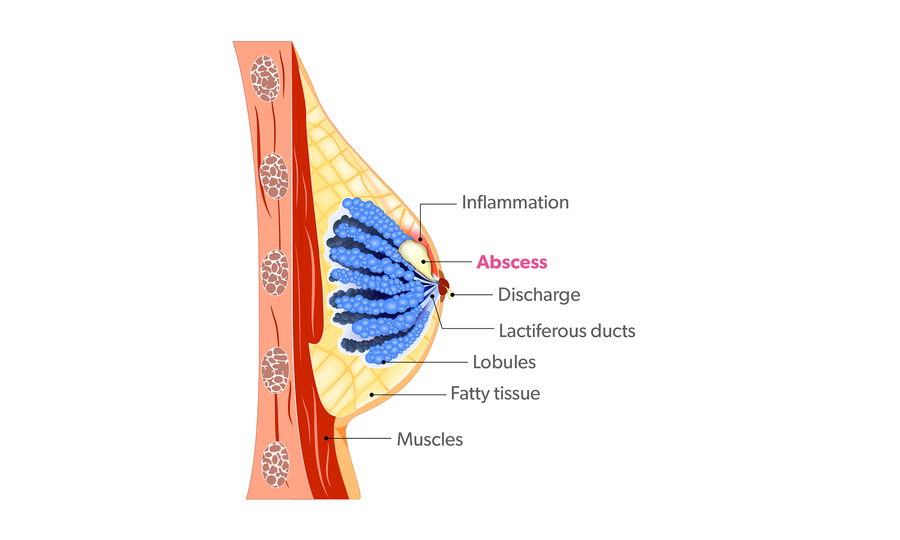 Understanding Back Pain and Large Breasts - KleinLipo