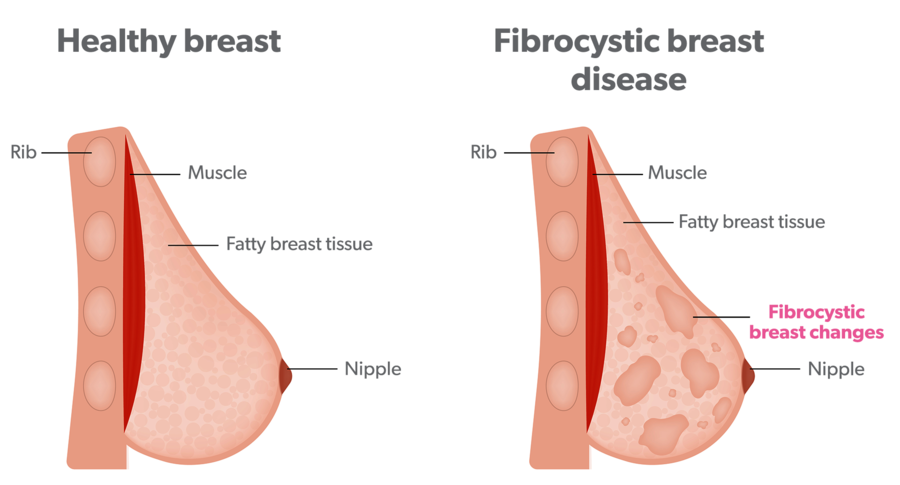 fibrocystic-diagram-breast-conditions.png