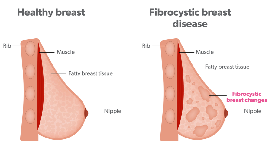 Breast pain  The 3 types of breast pain and their causes