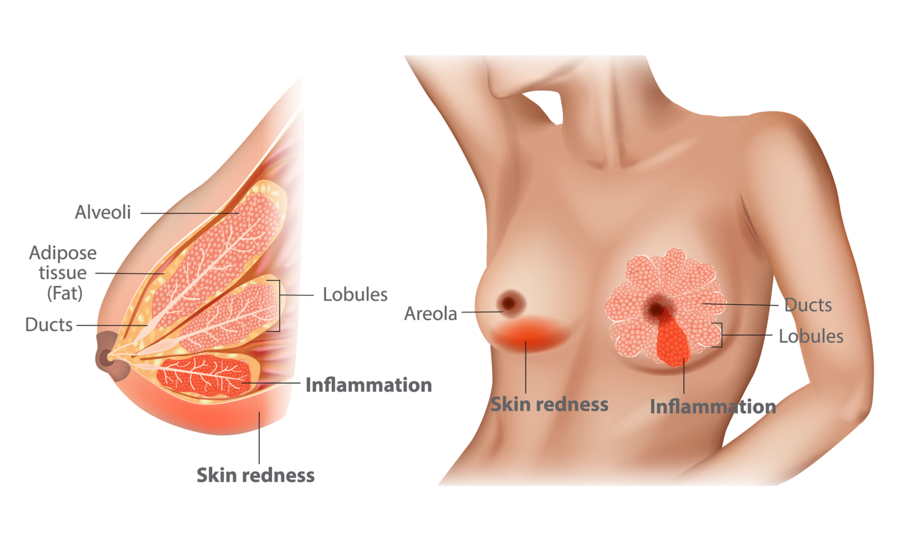 mastitis-diagram-breast-conditions.png