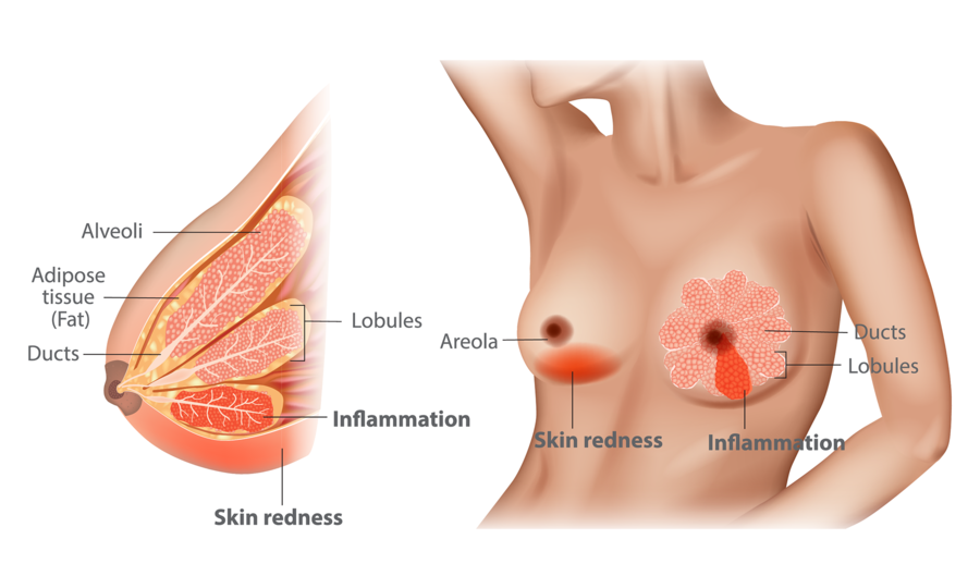 Understanding Under-Breast Soreness