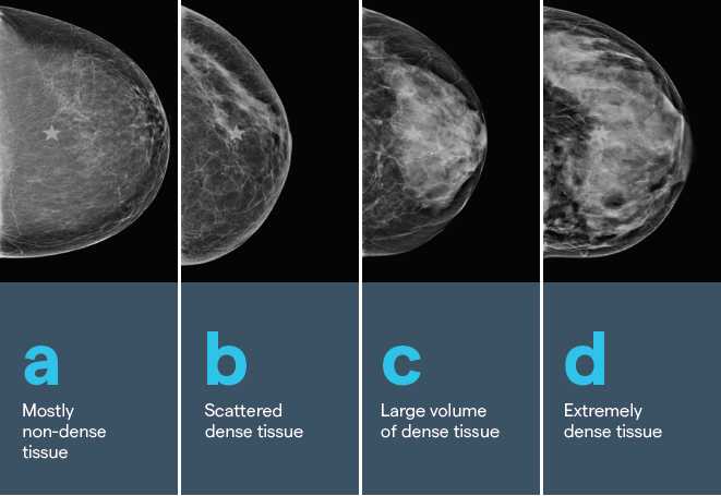 Breast mammogram shows Mass: What to do next