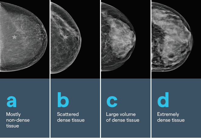 Grades of breast density (supplied by Volpara Health)
