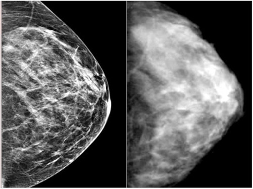 New advice issued to women about Covid-19 vaccinations and mammograms