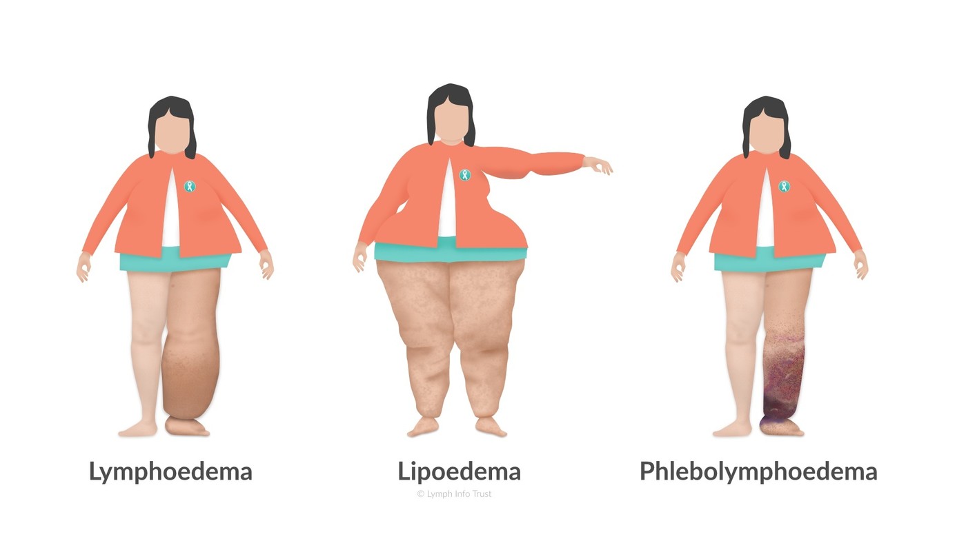 Lymph Info Trust