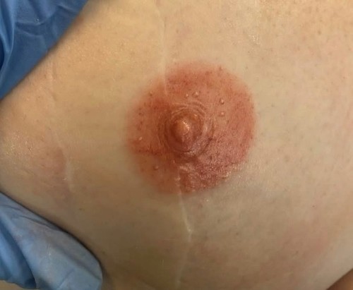 New advice issued to women about Covid-19 vaccinations and mammograms