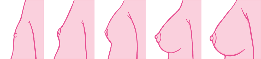 A small bump called a breast bud will develop under the nipple and areola (...