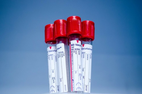 “Blood test for breast cancer” greatly exaggerated, says Breast Cancer Foundation