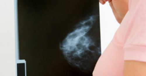 Mammograms: what you need to know