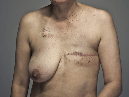 Scar therapy: caring for your surgical scars after a mastectomy