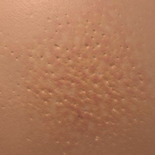 What Does Breast Cancer Orange Peel Skin Look Like Cancer Symptoms