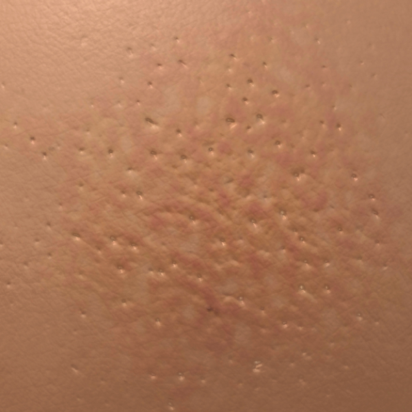 Breast Cancer Bumps Look Like Cancer Symptom